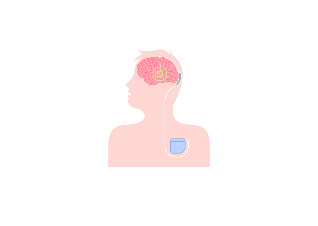 Z archivu: Centrum pro epilepsie Brno se stane Výcvikovým a výukovým centrem pro hlubokou mozkovou stimulaci (DBS) u pacientů s farmakorezistentní epilepsií